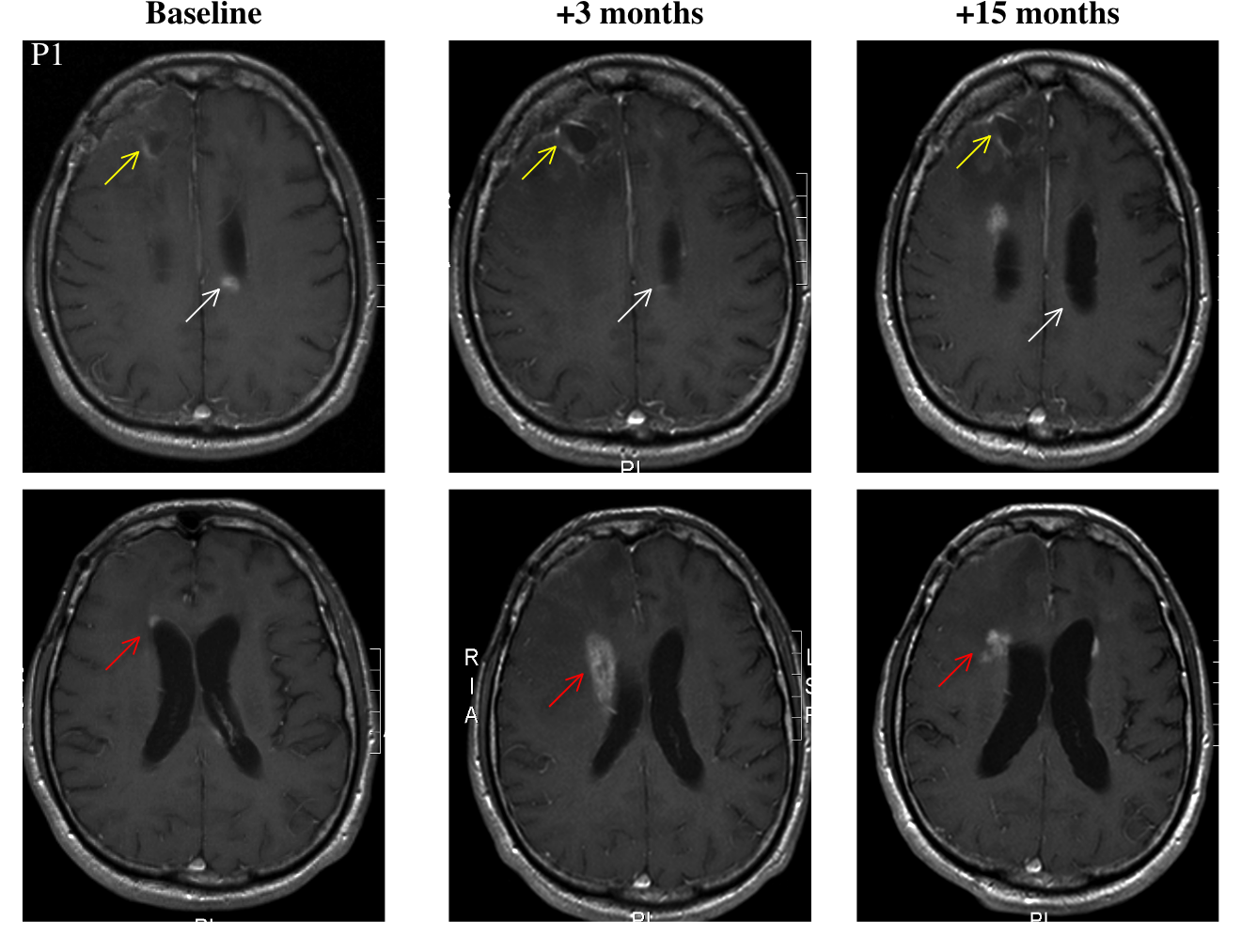 Patient 1 MRI