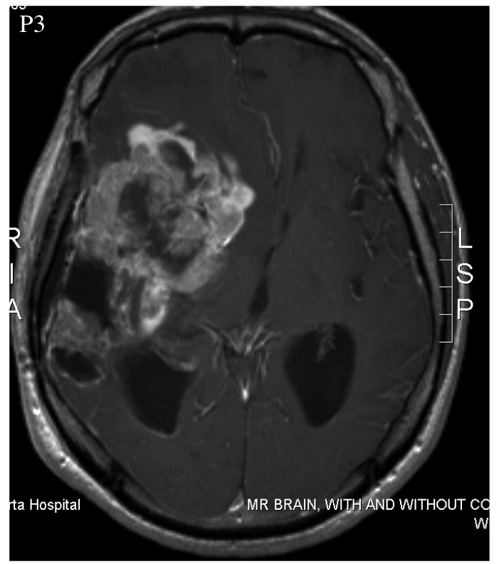 Patient 3 MRI