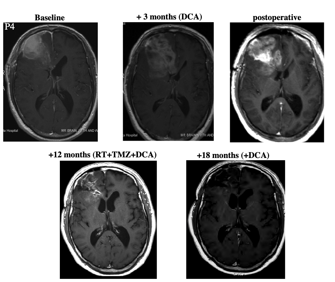 Patient 4 MRI