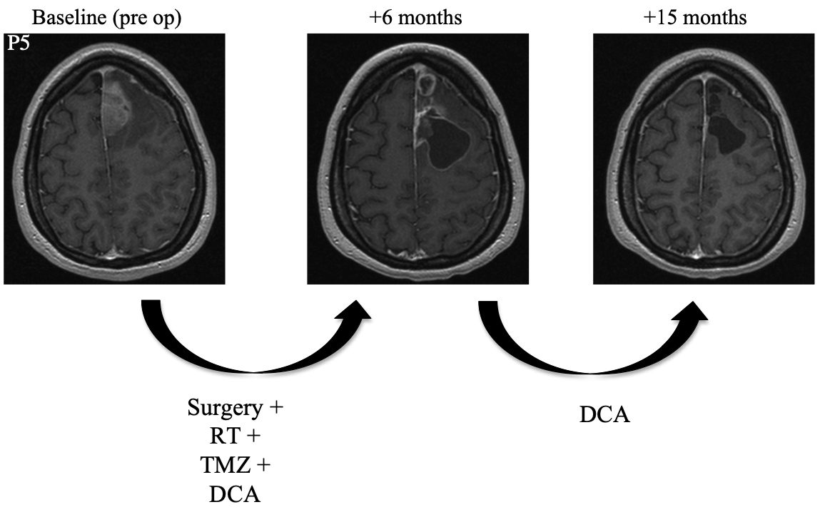 Patient 5 MRI